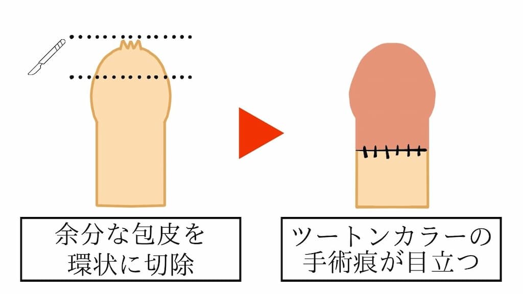 環状切開による包茎手術のビフォー・アフターイラスト。余分な包皮を環状にメスで切除し縫合する。縫い目を境に内板と外板でツートンカラーになる。