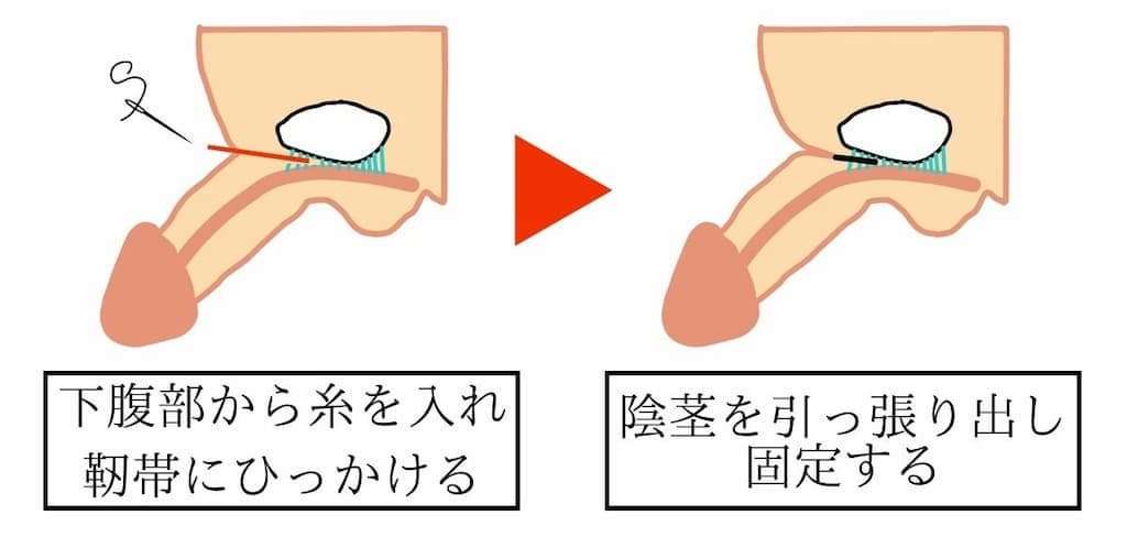 埋没陰茎長茎術（非切開法）について解説したイラスト。下腹部から医療用の糸を入れ、海綿体と恥骨を固定している『ワナ靭帯』にひっかけて埋没している陰茎を引っ張り出し固定する。