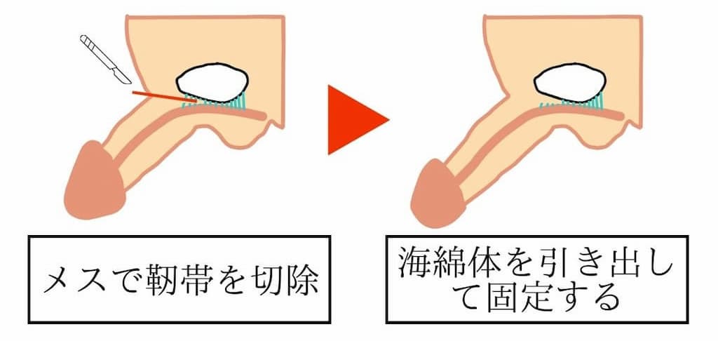 切る長茎術について解説したイラスト。切る長茎術は下腹部を2cm程度切開し、メスを使って『ワナ靭帯』を切除して恥骨との固定を解除し、海綿体を引き出した状態で『テイ靭帯』に固定します。