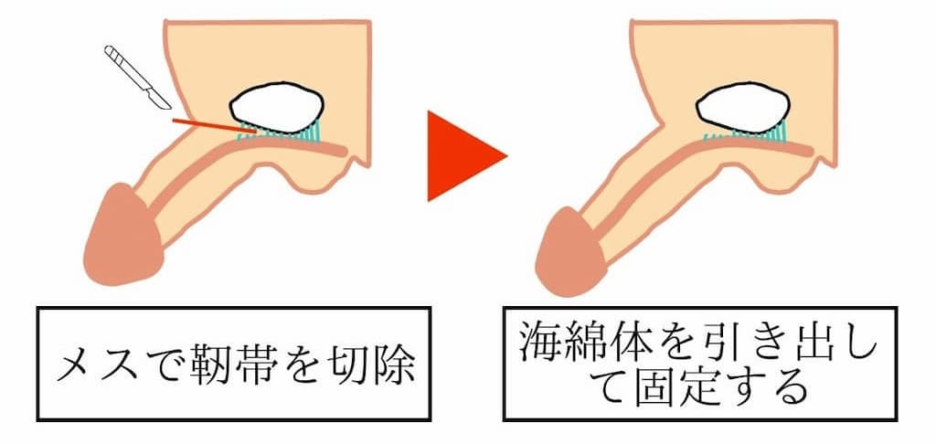 切る長茎術について解説したイラスト。切る長茎術は下腹部を2cm程度切開し、メスを使って『ワナ靭帯』を切除して恥骨との固定を解除し、海綿体を引き出した状態で『テイ靭帯』に固定します。