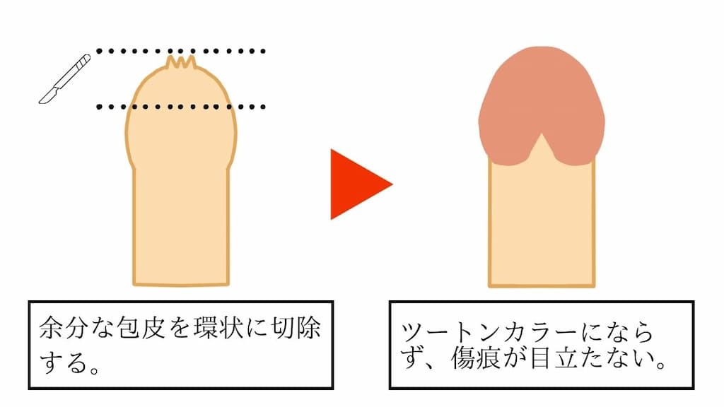 環状切開による包茎手術のビフォー・アフターイラスト。余分な包皮を環状にメスで切除し縫合する。縫い目を境に内板と外板でツートンカラーになる。