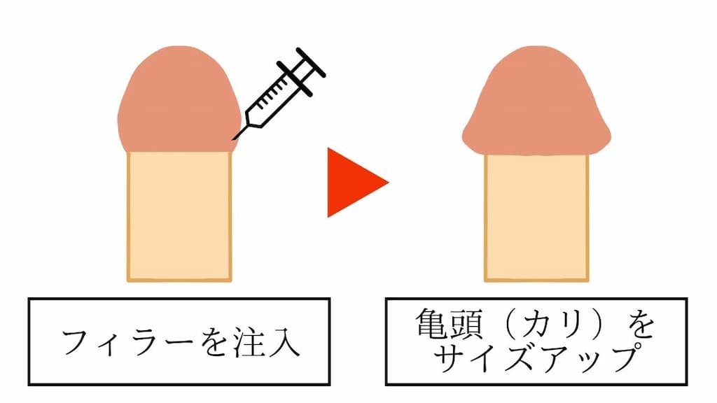 亀頭増大のビフォーアフターイラスト。亀頭のカリ部分に注射器でフィラーを注入すると亀頭がサイズアップする。