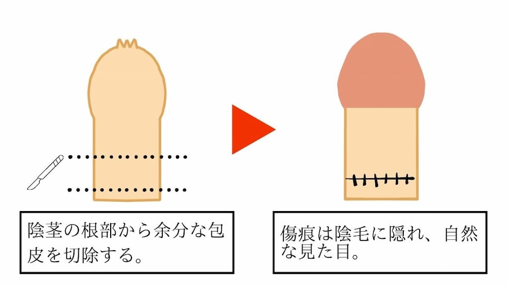 根部切開法による包茎手術のビフォー・アフターイラスト。余分な包皮を陰茎根部で切除し縫合する。縫い目は陰毛に隠れて目立たない。また、陰茎部分は自然な露茎と同じグラデーションになる。