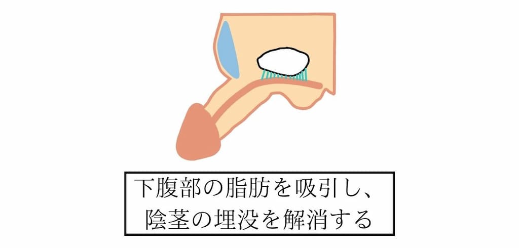 下腹部脂肪吸引式長茎術について解説したイラスト。陰茎上部にある下腹部の脂肪を吸引し、陰茎の埋没を解消する。