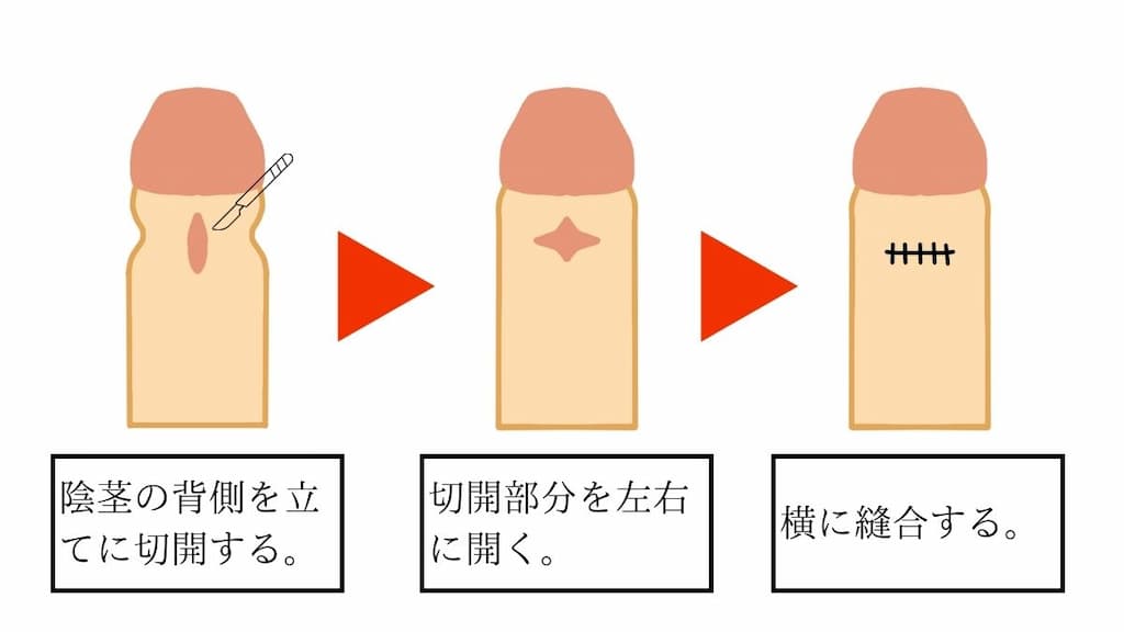 背面切開術による包茎手術のビフォー・アフターイラスト。余分な陰茎の背側で縦に切開し左右に拡げ、横のラインで縫合する。