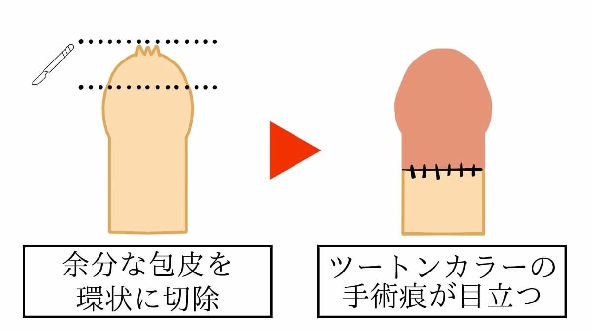 環状切開による包茎手術のビフォー・アフターイラスト。余分な包皮を環状にメスで切除し縫合する。縫い目を境に内板と外板でツートンカラーになる。